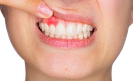   Verursacher odontogener Infektionen sind primär meist tief kariöse Zähne oder massiv entzündete Zahnfleischtaschen. Von dort dringen die Keime Richtung Wurzelkanal vor.